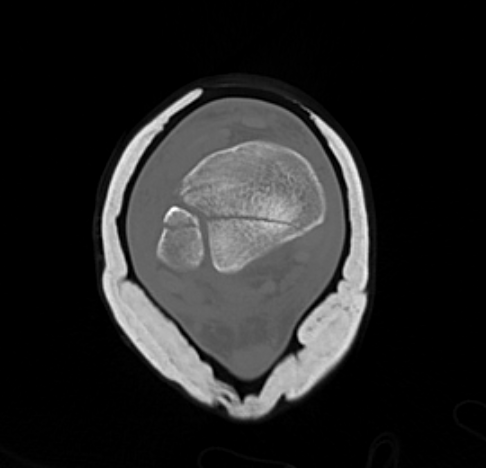 Distal tibia 4